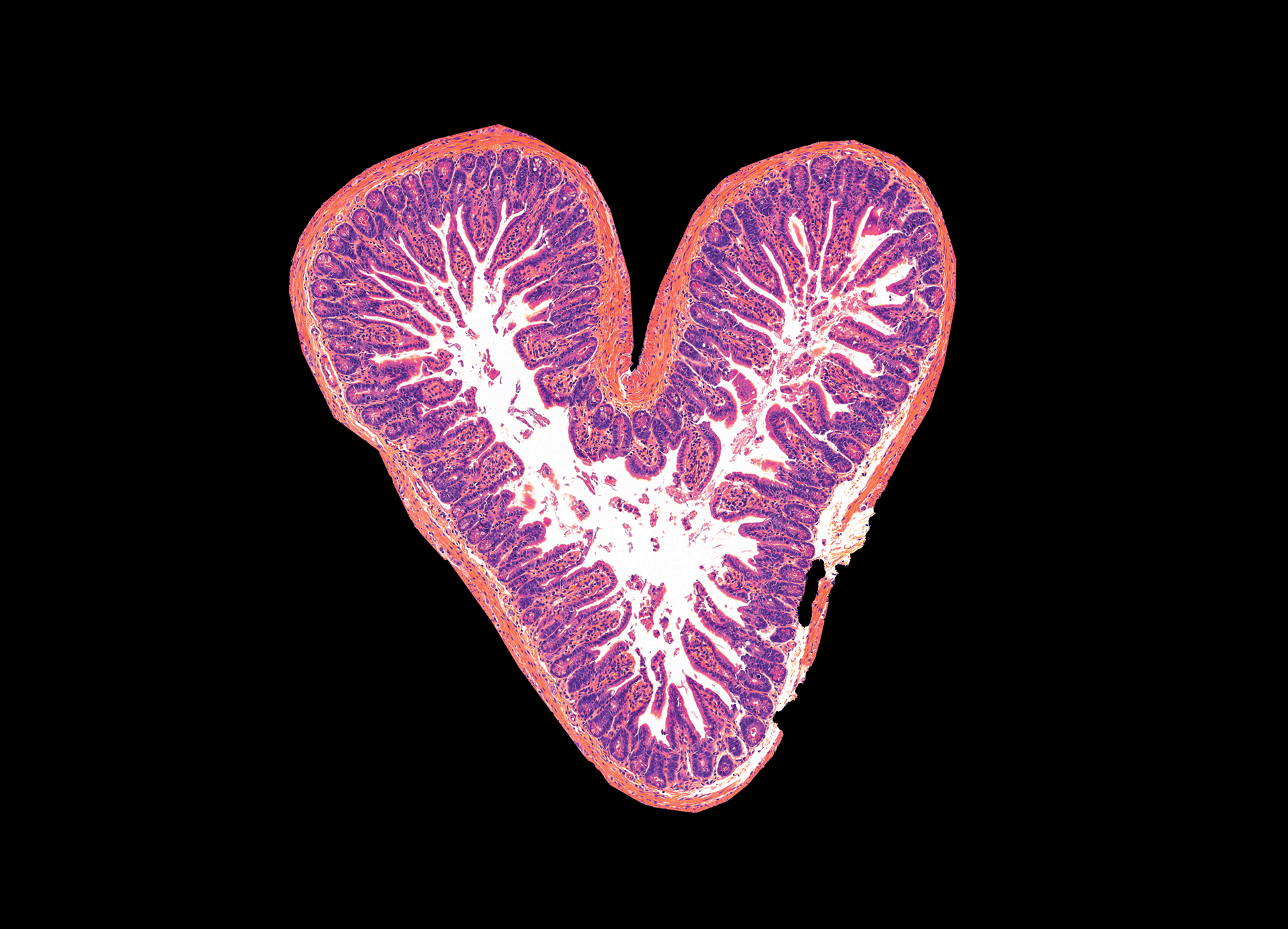 Microscope view of the intestinal wall showing damaged and dead cells in the finger-like villi that extract essential nutrients from digested food.